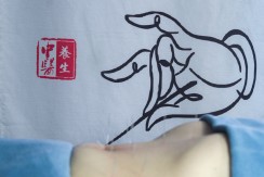 针灸